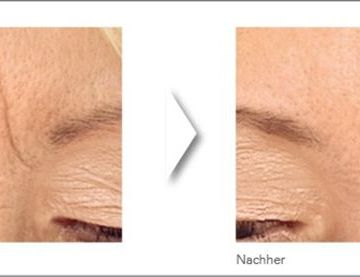Augmedica Anti Age - senkrechte und horizontale Stirnfalte