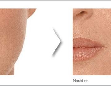 Augmedica Anti Age - Nasobialfalte