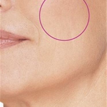 Augmedica Anti Age - Wangenbereich und am Decoltee