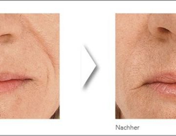 Augmedica Anti Age - Marionettenfalten