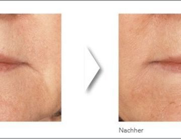 Augmedica Anti Age - Mentolabialfalten