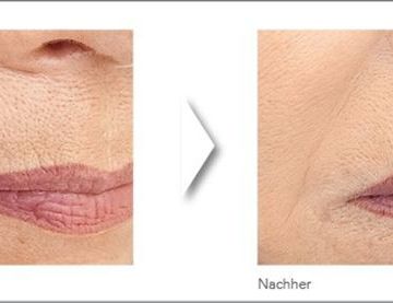 Augmedica Anti Age - Raucherfältchen