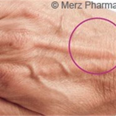 Augmedica Anti Age - flächige Hautverjüngung