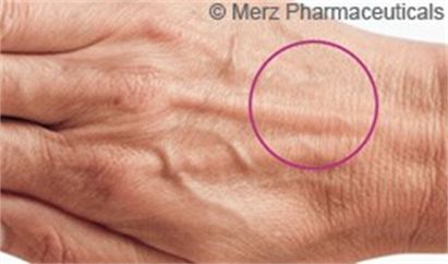 Augmedica Anti Age - flächige Hautverjüngung